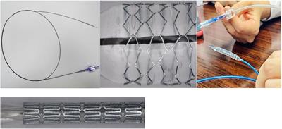 Initial status and 3-month results relating to the use of biodegradable nitride iron stents in children and the evaluation of right ventricular function